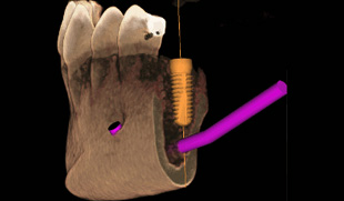 DVT - 3D-Implantatplanung / 3D-Röntgendiagnostik